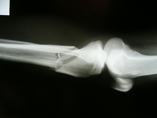 xray of joint